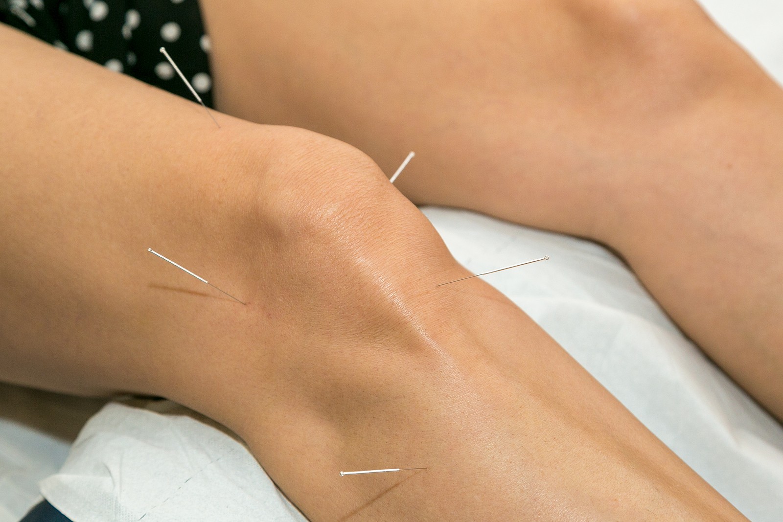 acupuncture-for-arthritis-in-knee