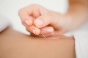 inserting-acupuncture-needle
