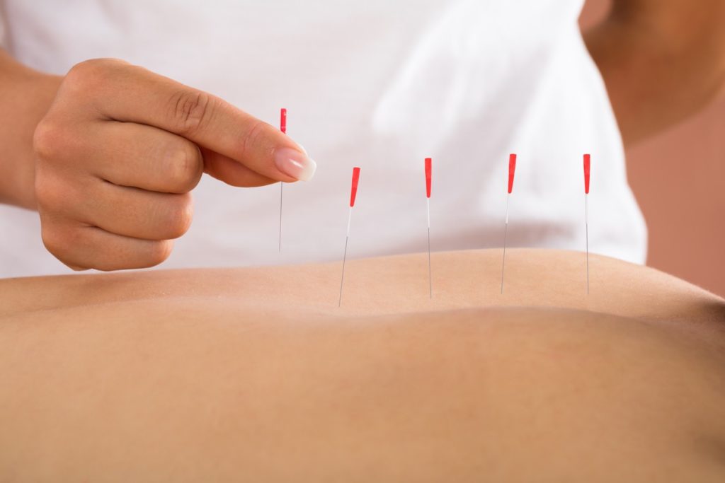 Benefits of Acupuncture for Insomnia Acupuncture in Bend, OR