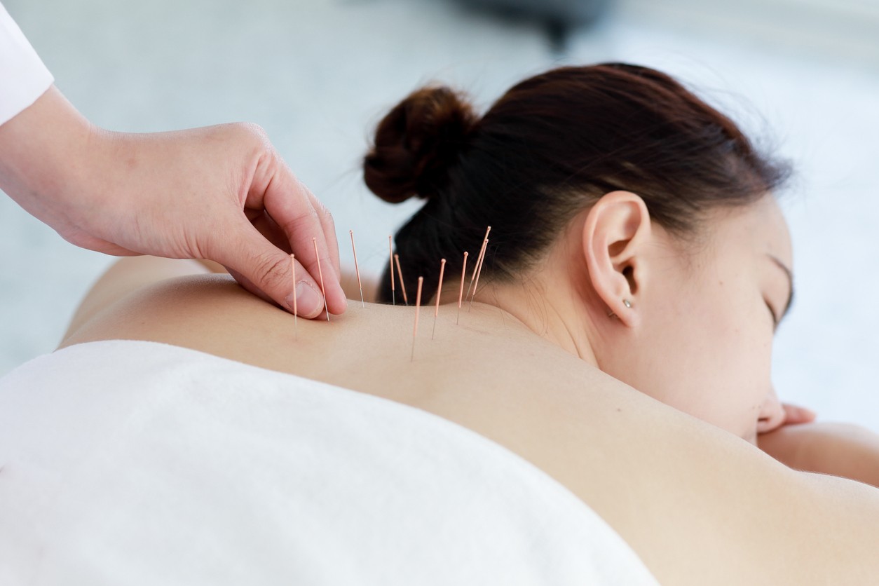 woman-getting-acupuncture-on-back