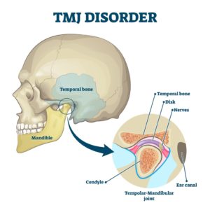 Illustration of the skull and jaw with a call out and close up view of the parts of the temporal-mandibular joint to depict TMJ disorder.