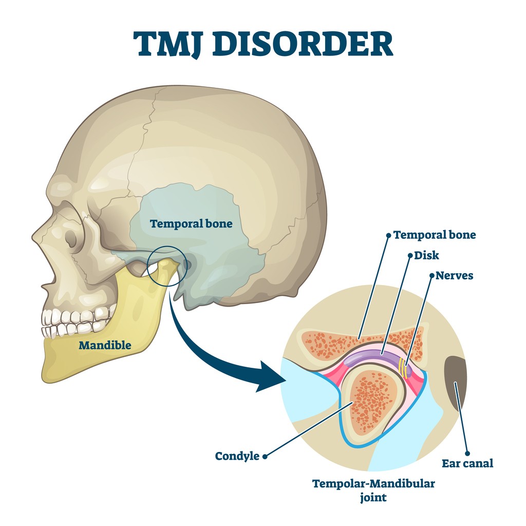 illustration-of-tmj-disorder