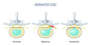 Illustration of herniated disc.