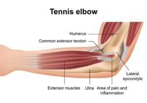 A graphic illustration of the parts of the elbow and where tennis elbow occurs.