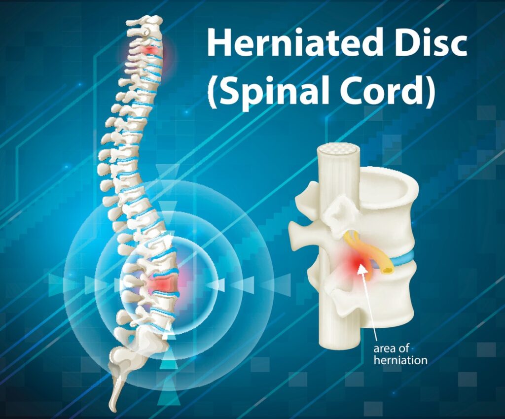 Infographic depicting a herniated disc in the spinal cord. 