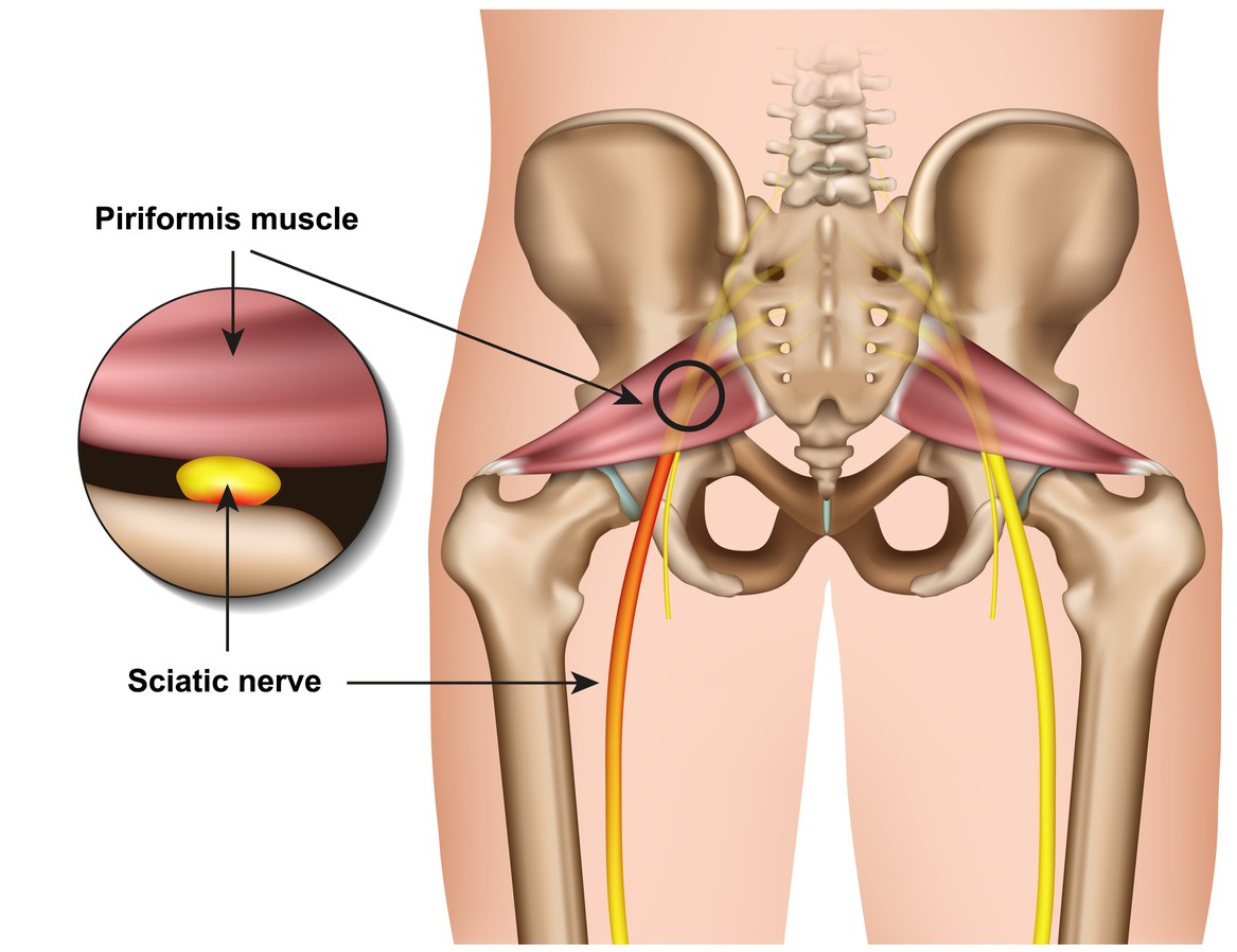 A graphic illustration depicting piriformis syndrome. 