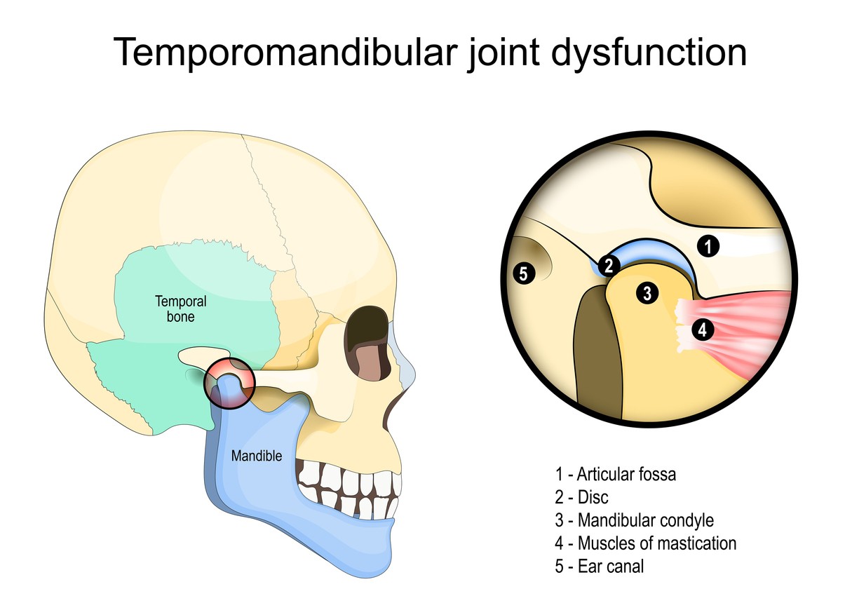 A graphic depicting temporomandibular joint dysfunction or TMJ. 