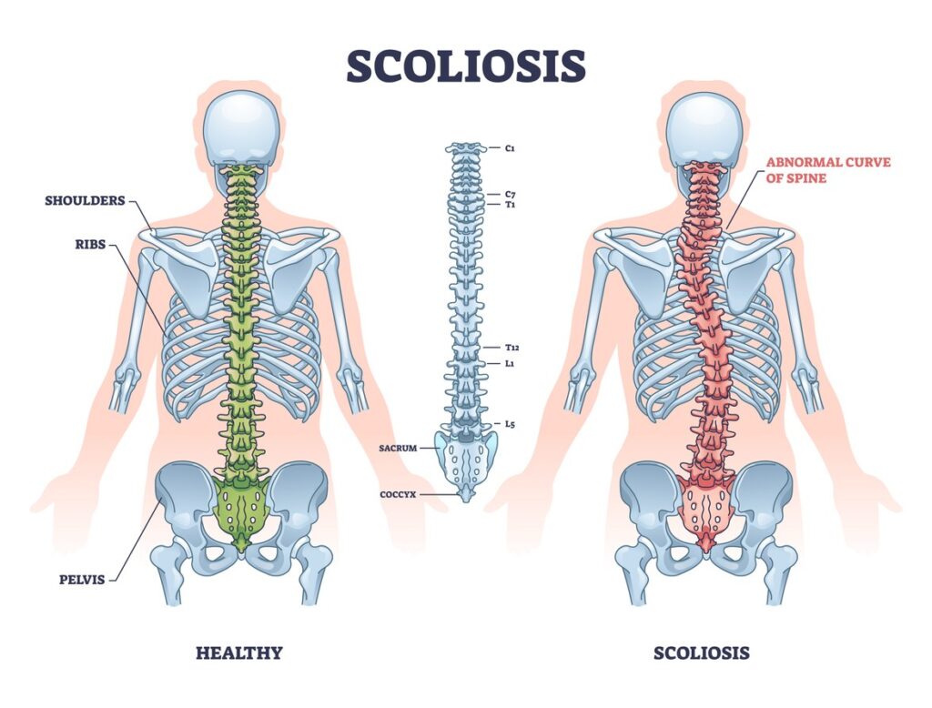 Managing Scoliosis With Chiropractic Care Bend Or Chiropractor
