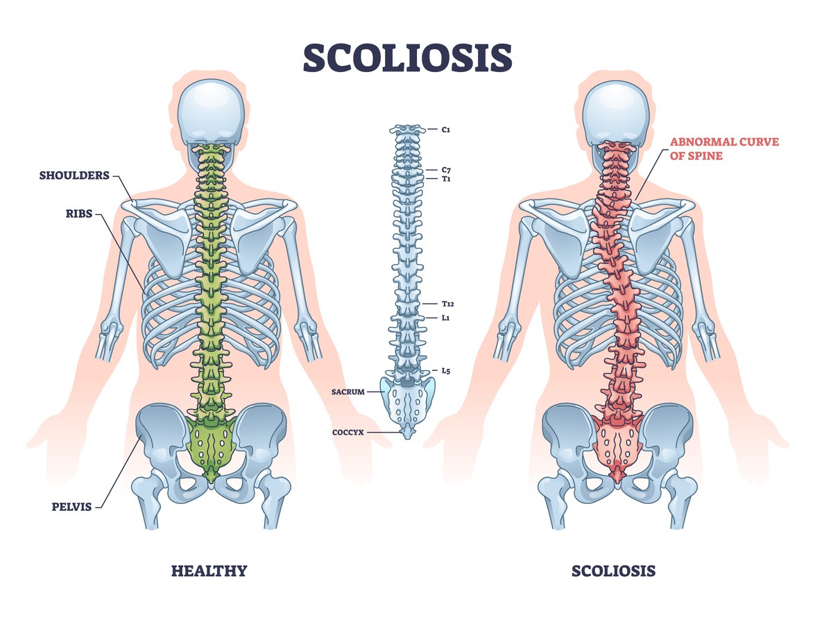 A graphic depicting a healthy spine compared to one with scoliosis. 