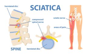 An graphic depicting where sciatica occurs in the human anatomy.
