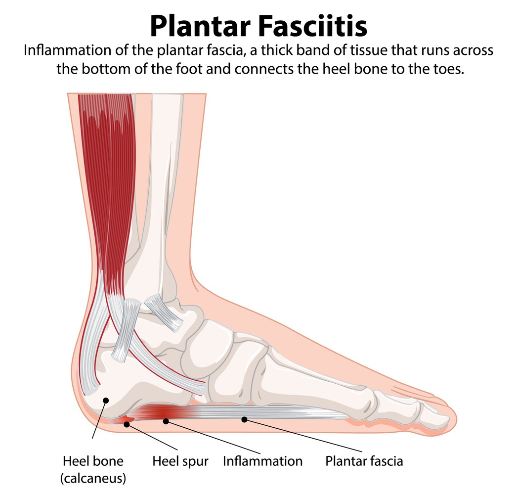 An infographic of the foot and demonstrating what happens during plantar fasciitis. 